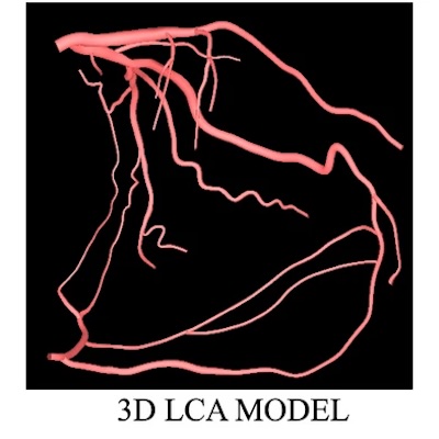 3D model of left coronary artery with detailed branching.