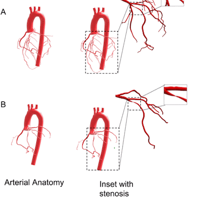 Rendering of arterial model