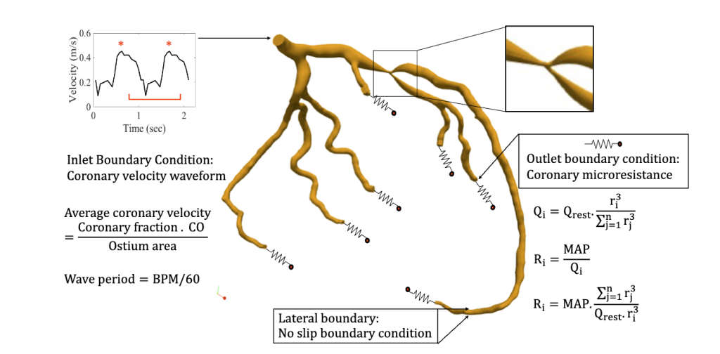 Computational model of coronary artery bifurcation with boundary conditions.