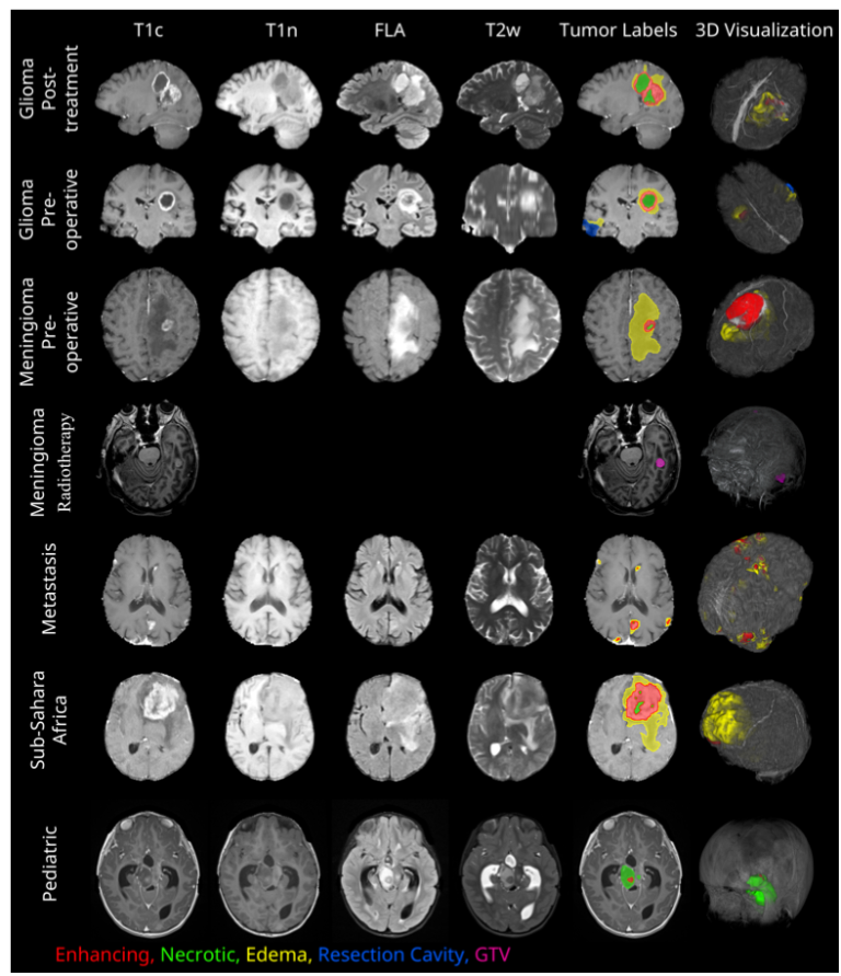 Illustration of the different segmentation tasks for diverse brain tumor types within the BraTS segmentation challenges