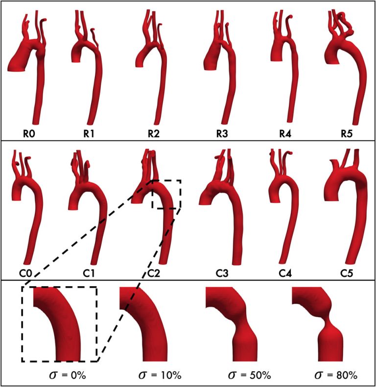 Baseline aortic geometries of repaired coarctation patients (top row) and healthy control patients (middle row.) Each geometry is paired with its matched control (e.g., R0 with C0, R1 with C1, etc. Bottom row, from left: Representative geometry with stenosis σ = 0 % (unmodified baseline), 10%, 50%, and 80%.
